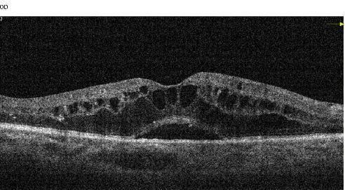 糖尿病性黄斑水肿的oct表现1)糖尿病性黄斑水肿4.