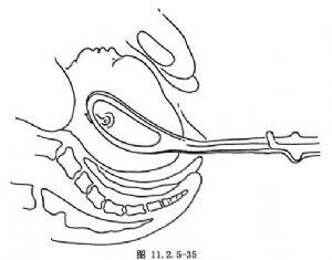 颏后位不能经阴道分娩,颏前位可行产钳术助产,其手术步骤与低位产钳术