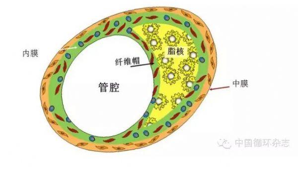 纤维帽是否稳定决定了血管是否会发生意外
