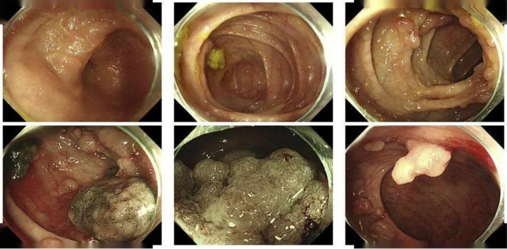息肉明明是良性肿瘤为何会恶变