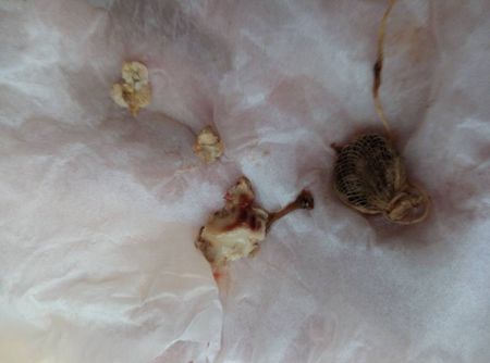 问:我属于重度宫颈糜烂,白带有很大的腥味,色去痰黄偶带血丝,腰酸.