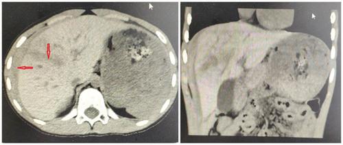 查体可见小朋友右侧肋弓处皮肤擦伤,ct片示右肝叶破裂,裂口长达8