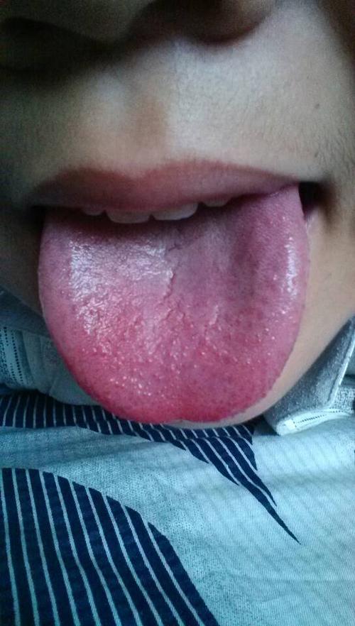 如果有的话,考虑是手足口病  4 3 已赞过 已踩过   你