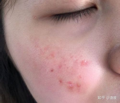 面部毛囊炎如何治疗