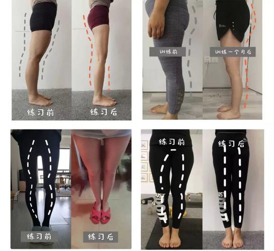xo型腿/肌肉腿/小腿外翻的人,注定与大长腿无缘吗?