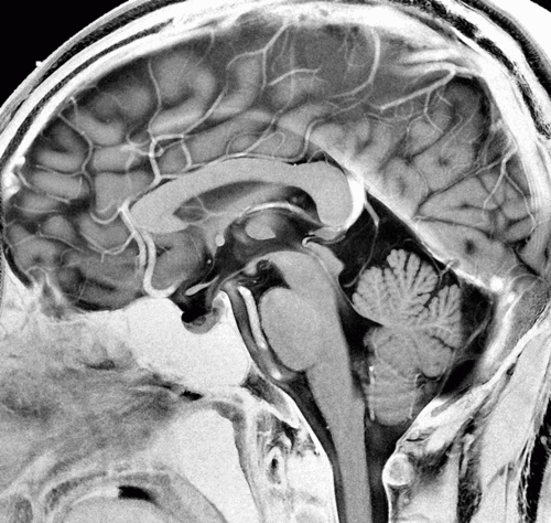 高分辨率磁共振成像mr病理切片