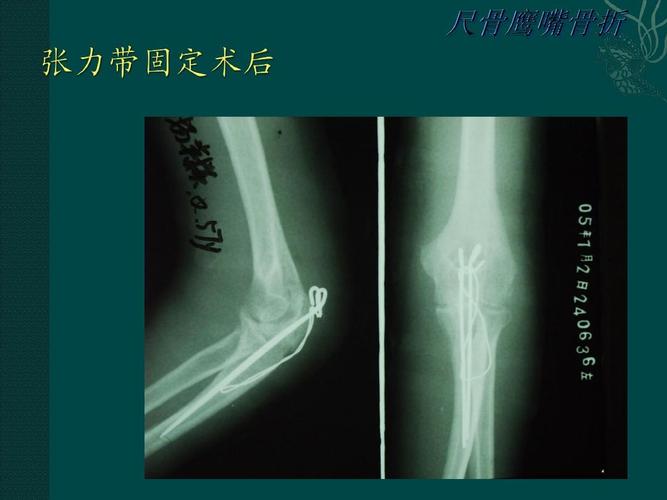 尺骨鹰嘴骨折ppt