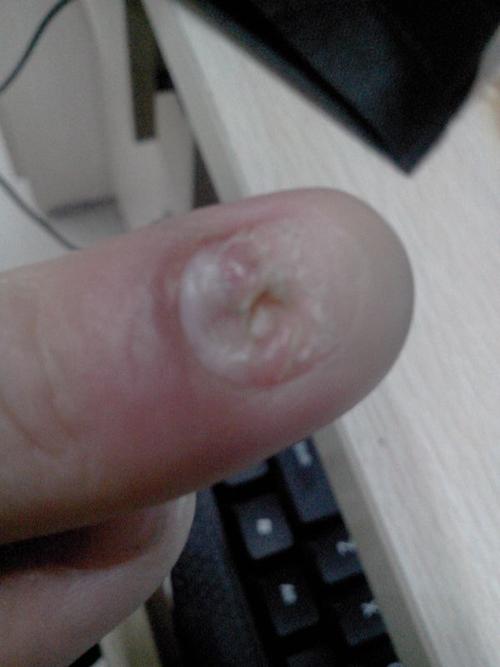 我一个月前手指甲被门夹掉了,到现在感觉一
