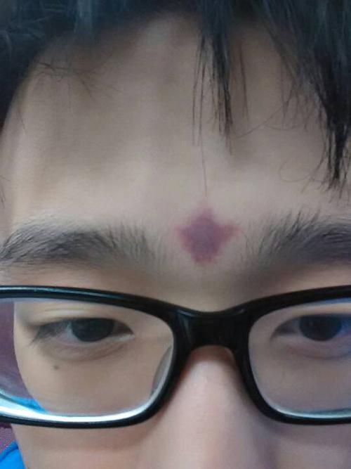 为什么我额头上被室友掐了就红成这样