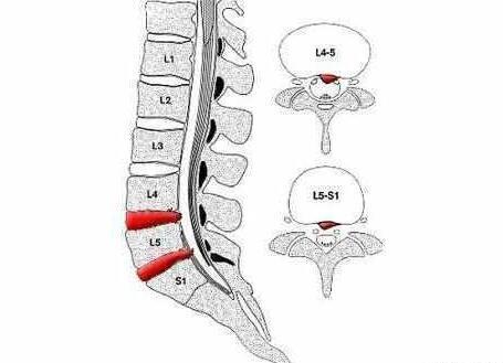 往往可以通过脚背麻木依旧脚底麻木来判断腰椎间盘突出的具体节段