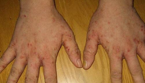 治疗疥疮的偏方有哪些内服和外用偏方为您介绍