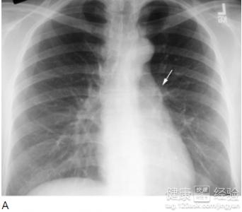 1x线胸片检查,ct扫描一般情况通过x线胸片检查,间质性肺炎晚期较容易