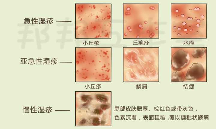 湿疹是以形态学描述来命名的一种皮肤病,由多种内外因素引起的具有