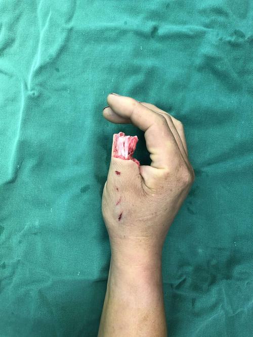 拇指末节缺损～"移花接木"手术再造