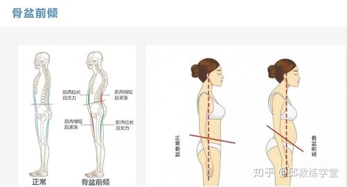 骨盆前倾/骶骨上翘