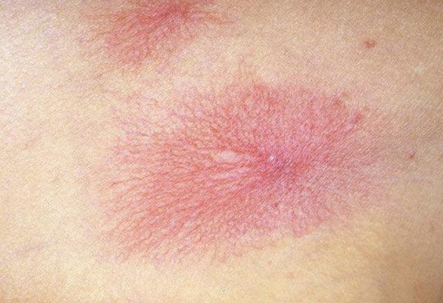 网帖让她怀疑自己患上乙肝 医生:身现这种红痣请到医院做检查