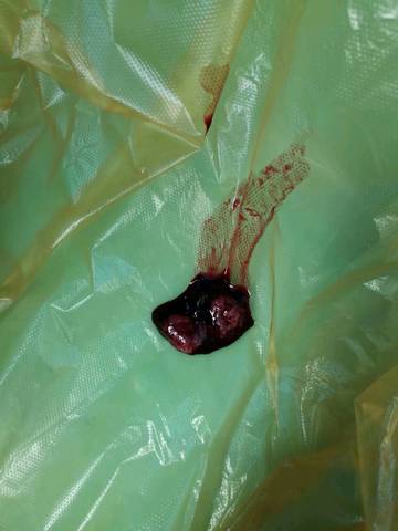 去掉血块 用水冲了一下就变成两半了 都有绒毛 是双胞胎还是一个孕囊?