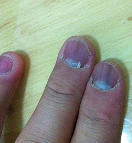 指甲发紫是什么原因 通过指甲颜色透露健康状况