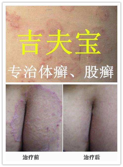 股癣治疗需要多长时间答:股癣是发生于腹股沟,大腿内侧上部及外阴部