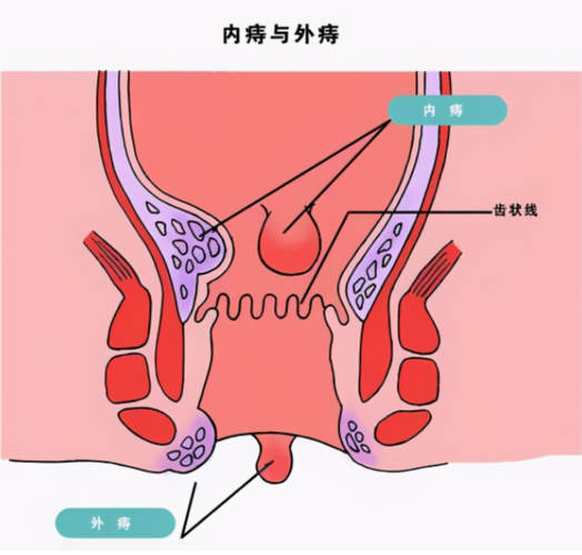 得了痔疮就一定要做手术