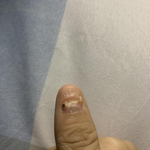 (慎入)上个月把指甲拔了以后 不知道怎么养