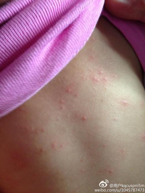 麻烦帮我看看宝宝后背长的什么?