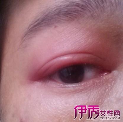 是睫毛毛囊附近的皮脂腺或睑板腺的急性炎症,相当于皮肤的疖肿.