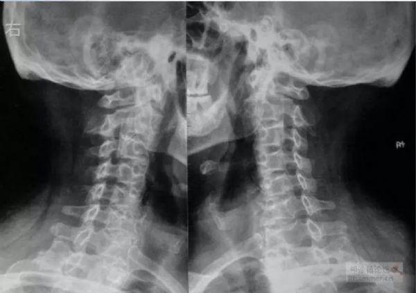 颈椎片:骨质增生