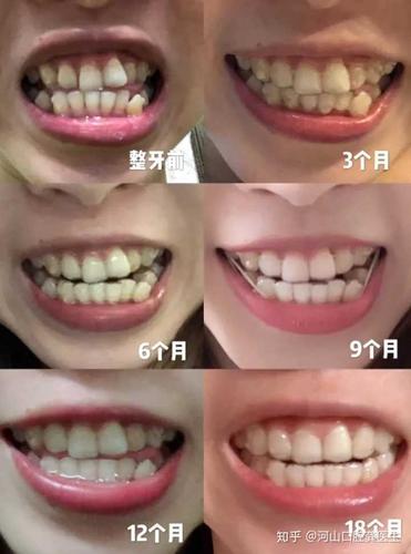 牙齿矫正手术对大部分人的身体是没有危害的,而且先天性牙齿不整齐