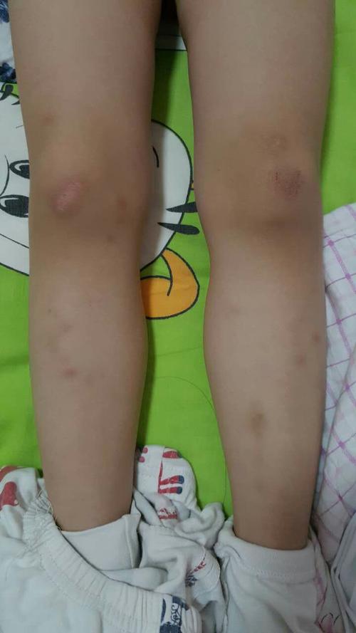 有没有人知道这是不是白血病或者骨癌之类早期病症?谢谢,.