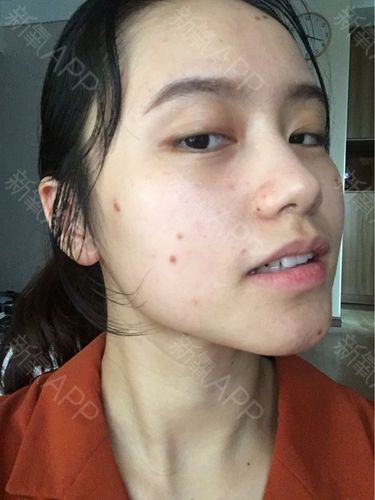 宛宴小仙女激光点痣术后第7天美丽日记_新氧整形