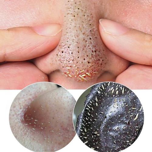 05999999去黑头就是指用_圈子-新氧美容整形