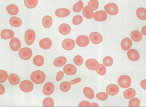 (图) 靶形红细胞