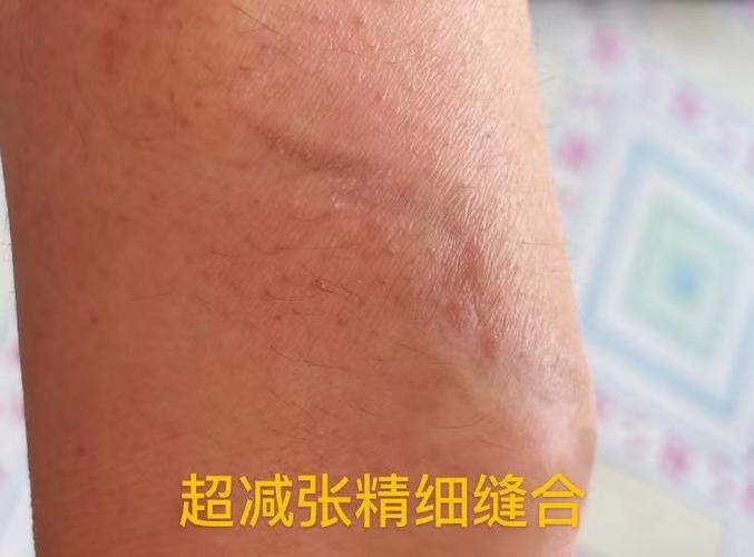 普通外科手术缝合技术和整形外科手术超减张精细缝合技术的区别