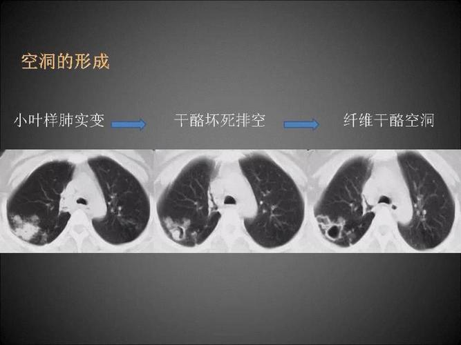 肺结核活动性的判定及相关知识点——路希维院长,伍建林教授