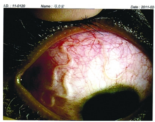 如果它们到达您的眼睛,它们会导致失明. 弓蛔虫病(toxocariasis)