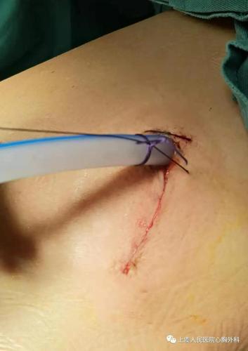 早期肺癌不要慌 微创手术除病灶