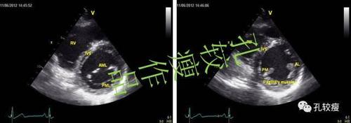 一文读懂心脏超声基本切面
