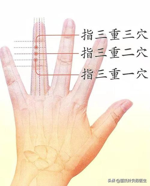 董氏针灸指三重,可以治疗青春痘,乳腺纤维瘤等