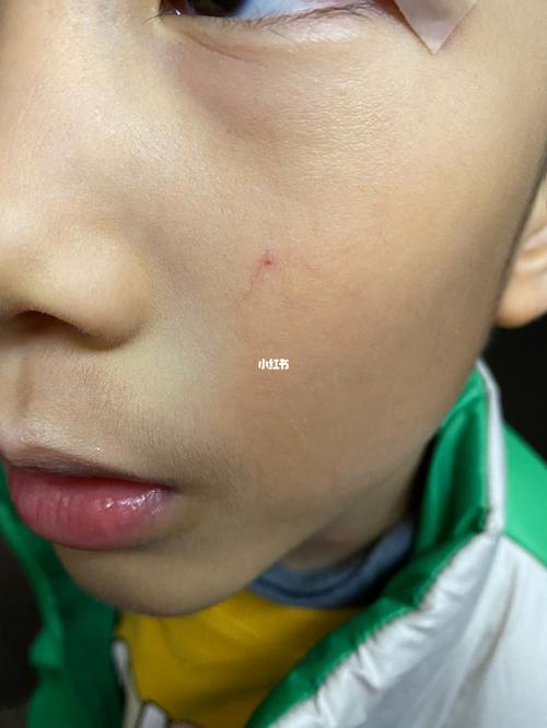 娃去激光蜘蛛痣了 记录95_红印怎么样_扩散_防晒_冰袋_药膏_皮肤科