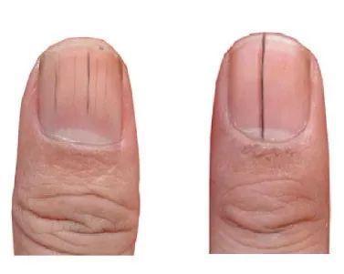 指甲上发现有竖纹可能和这5个原因有关别再乱猜吓唬自己