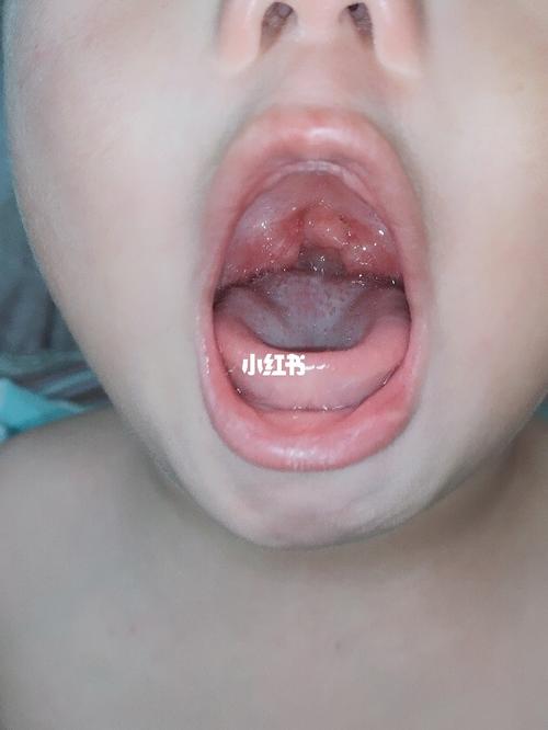 宝宝扁桃体发炎 中医还真有效_扁桃体_发炎_推拿_中医_发烧_母婴_育儿
