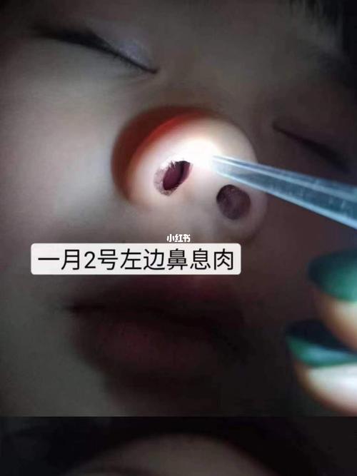 孩子鼻息肉,医院要求手术,用了鼻炎膏2天小这么多,妈妈高兴的要哭