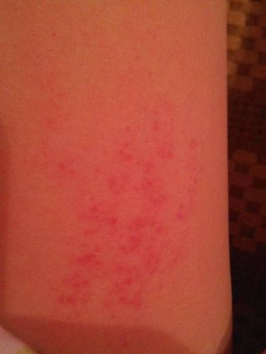 问:我每次洗澡的时候只要痒我稍微抓抓就会出现很多红点点像过敏似的