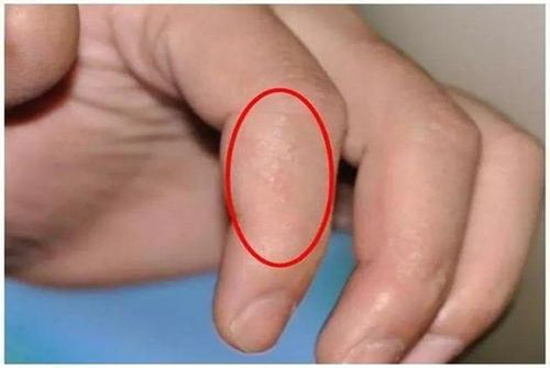 宝宝手上起小水泡是怎么回事 原来都是它的错