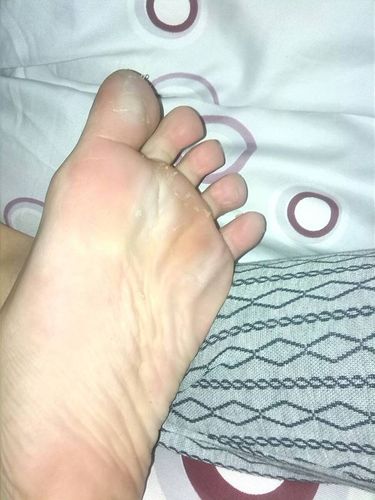 脚老爱出汗,每天洗脚也是这样,还很臭.请