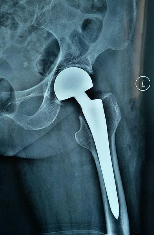 股骨颈骨折半髋关节置换术后