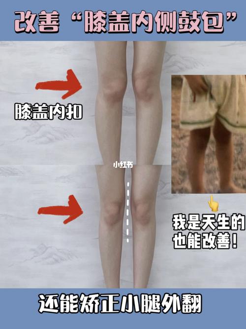 改善"膝盖内扣"专项|小腿外翻,膝盖内侧鼓包_小腿外翻
