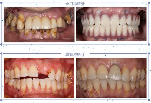 做种植牙需要具备哪些条件呢?