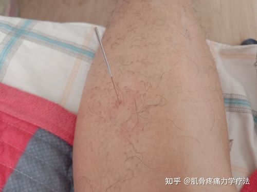 闲的没事,针灸一下